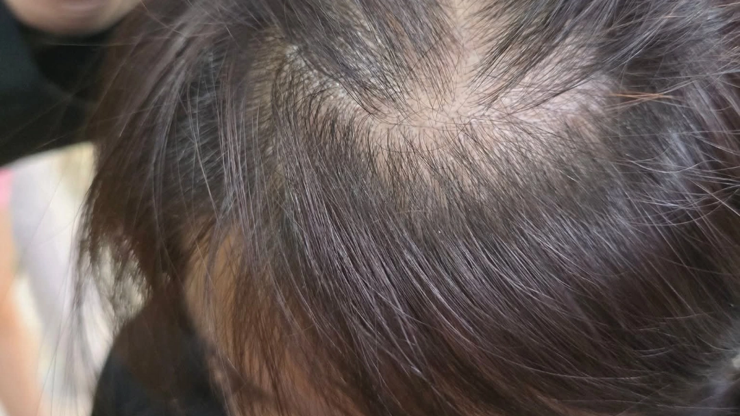 Hair Follicle Rejuvenation